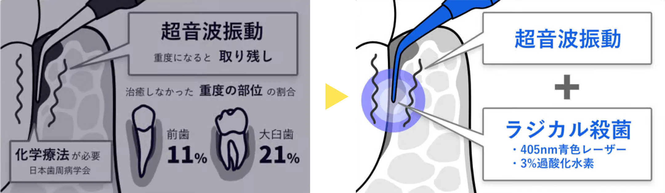 従来の治療法と「ブルーラジカル」の違いを表した図